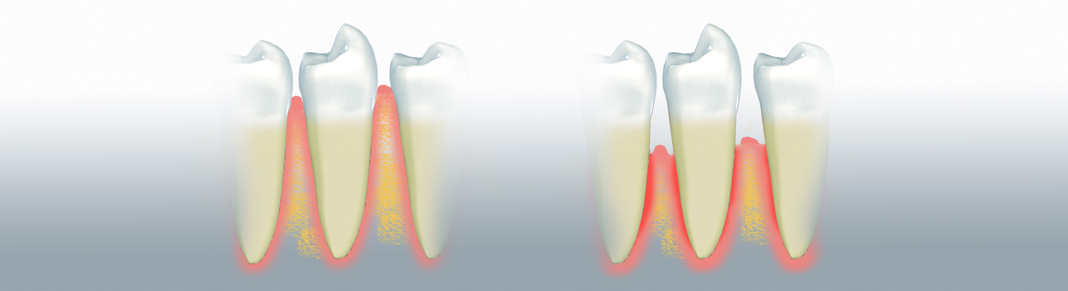Bakterien, die sich zwischen Zahn und Zahnfleisch ansammeln können eine Parodontitis auslösen Bakterien, die sich zwischen Zahn und Zahnfleisch ansammeln können eine Parodontitis auslösen 