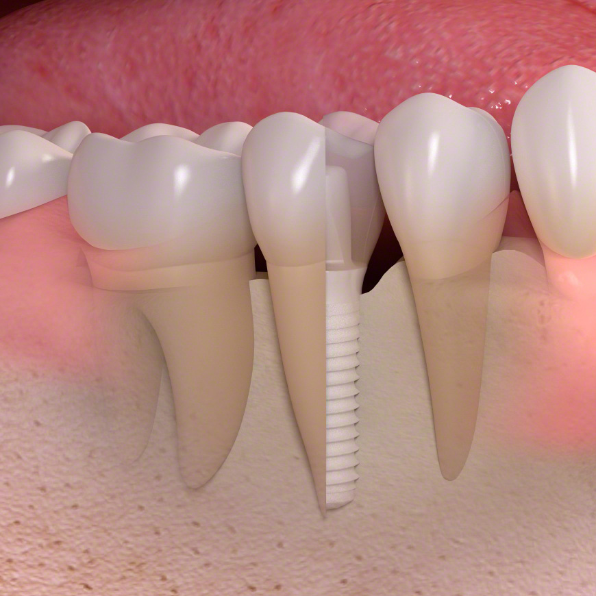 Querschnitt durch ein Keramikimplantat