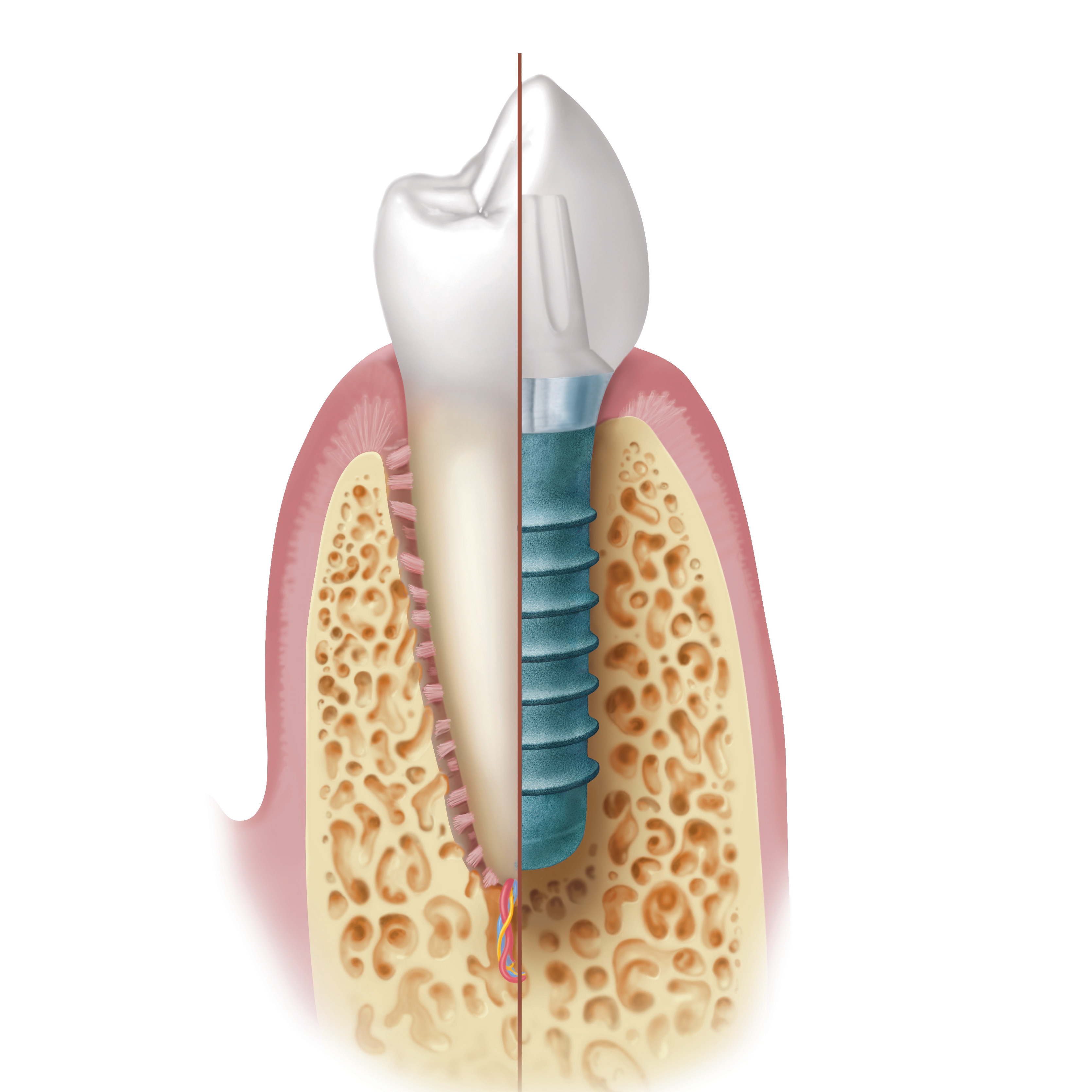 Das Implantat übernimmt die Aufgaben der Zahnwurzel.