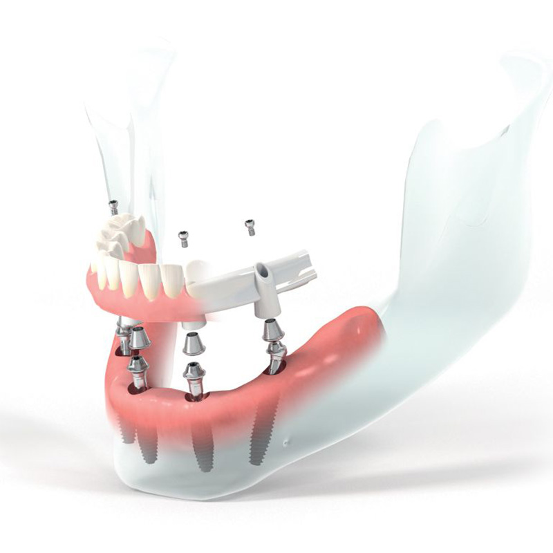 Implantatgetragene Prothese auf 4 Implantaten