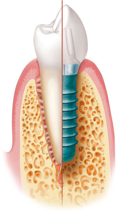 Natürlicher Zahn im Vergleich mit implantatgetragenem Zahnersatz