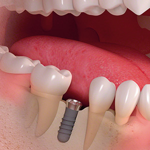 Ein fehlender Zahn wird durch ein Zahnimplantat ersetzt