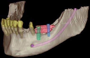 Digital implant planning