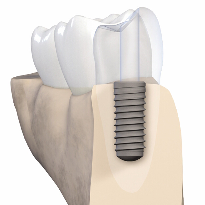 Güvenlik sunan implant sistemleri