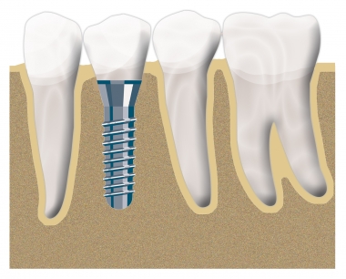 Implant position