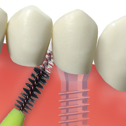 Mechanische S&auml;uberung eines Implantates mit einer speziellen Titanb&uuml;rste