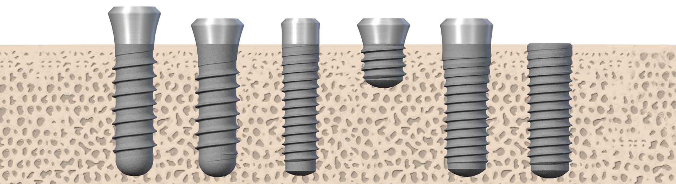 Dreidimensionale Darstellung einer Implantatschraube mit Aufbau