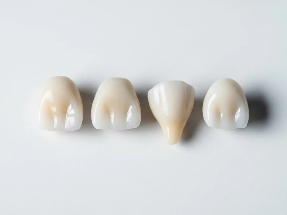 All-ceramic crowns on the plaster model