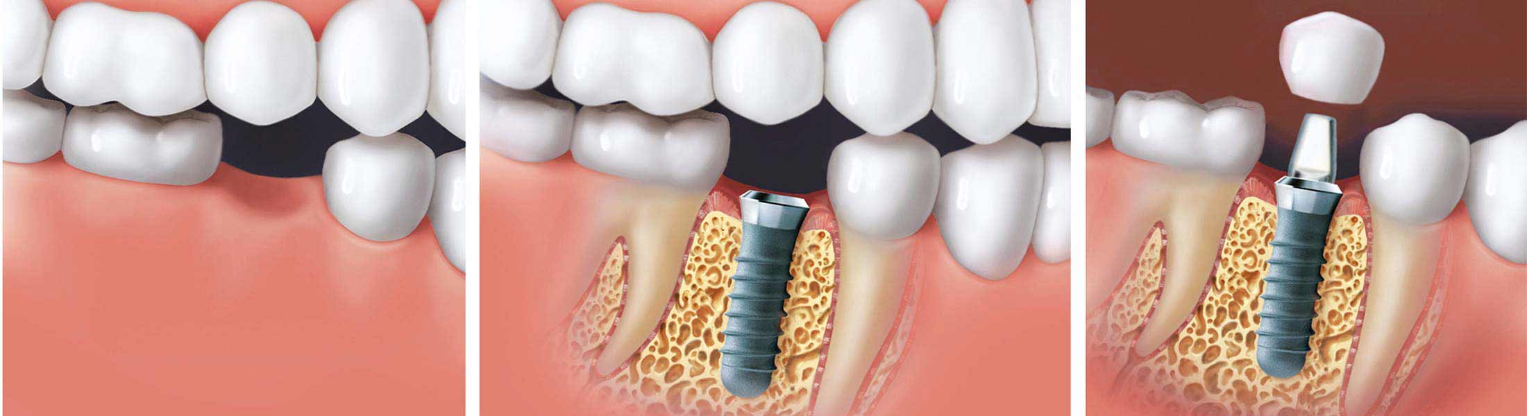 Implantat mit Aufbau wird in die Zahnl&uuml;cke eingesetzt, schematisch
