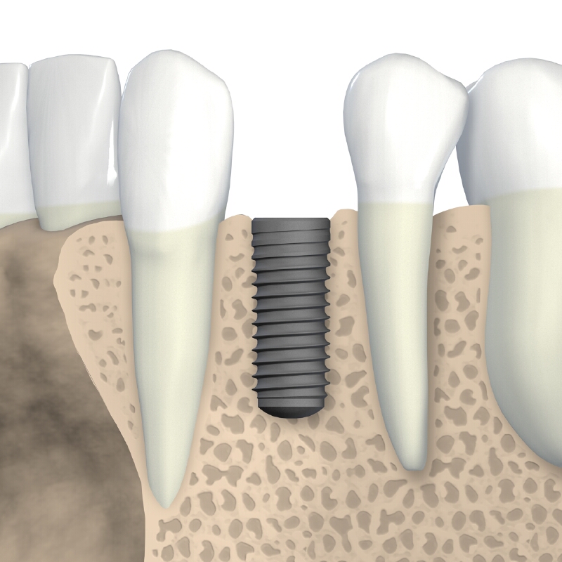 Eingeheiltes Implantat im Kieferknochen, schematisch